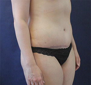 Tummy Tuck