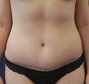 Tummy Tuck