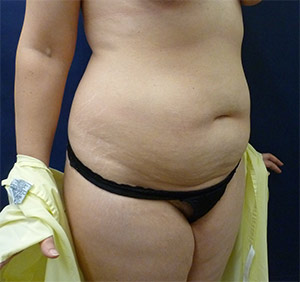 Tummy Tuck