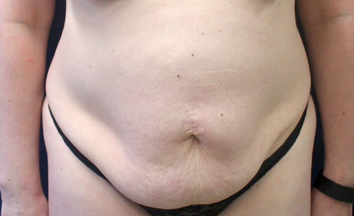 Tummy Tuck