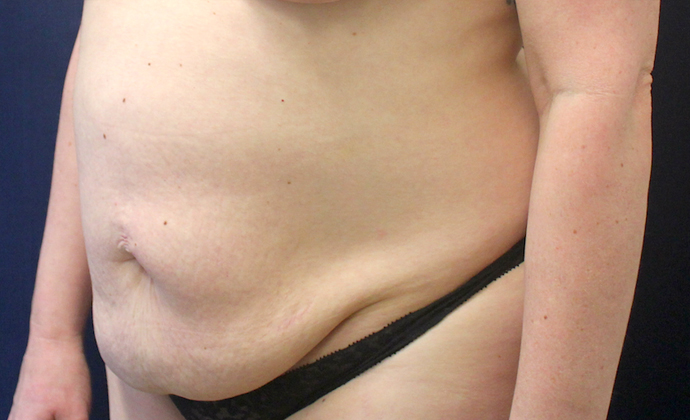 Tummy Tuck