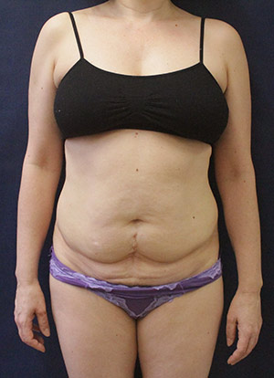 Tummy Tuck