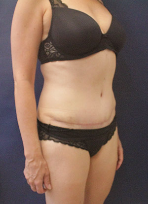 Tummy Tuck