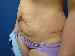 Tummy Tuck