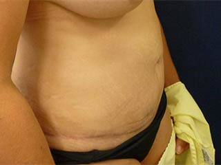 Tummy Tuck