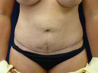 Tummy Tuck