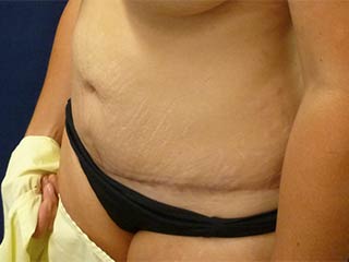 Tummy Tuck