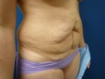 Tummy Tuck