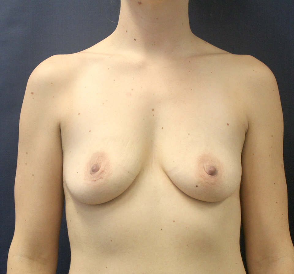 Breast Augmentation with Lift