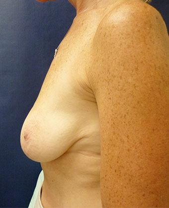 Breast Augmentation with Lift