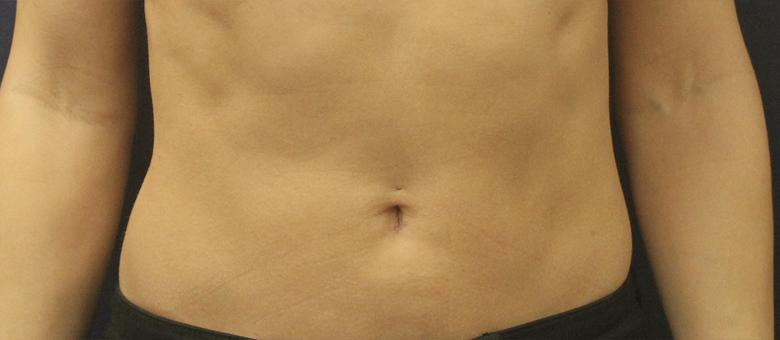 Liposuction