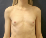 Breast Augmentation