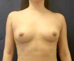 Breast Augmentation