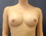 Breast Augmentation