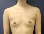 Breast Augmentation