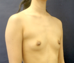 Breast Augmentation