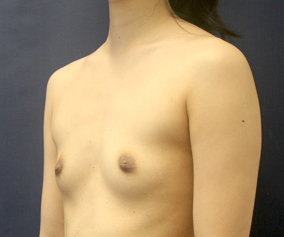 Breast Augmentation