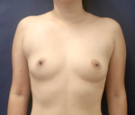 Breast Augmentation