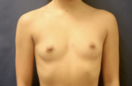 Breast Augmentation