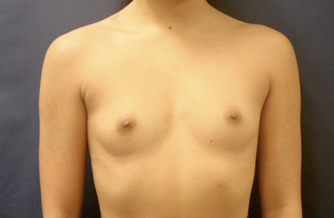 Breast Augmentation