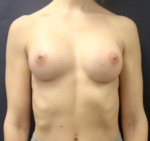 Breast Augmentation