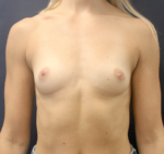 Breast Augmentation