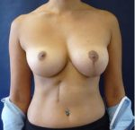 Breast Asymmetry