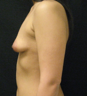 Breast Asymmetry Case 6759 Before Photo Breast Asymmetry