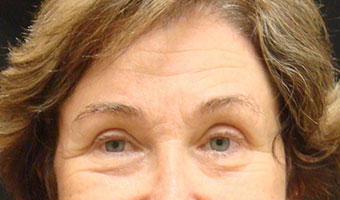 Eyelid Surgery Before and After Results