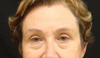 Eyelid Surgery Before and After Results