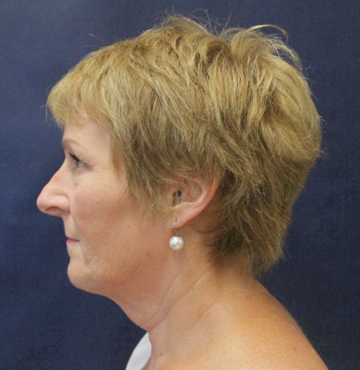 Neck Lift Before and After Results