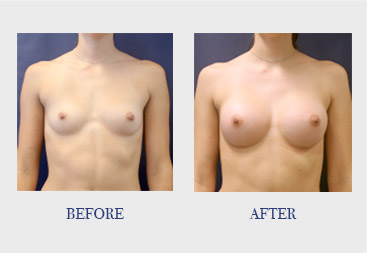 Breast Procedure Before & After