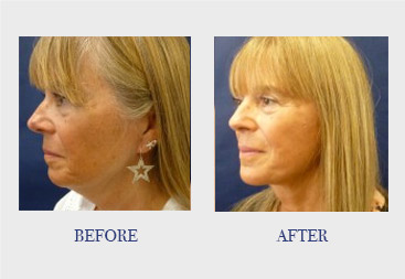 Face Procedure Before & After