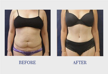 Breast Lift in Portland, OR  Athēnix Advanced Plastic Surgery